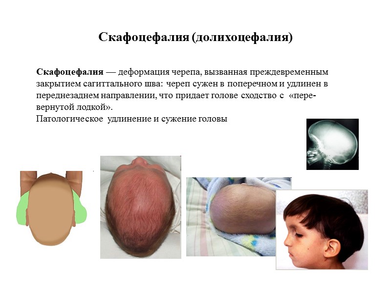 Скафоцефалия (долихоцефалия) Скафоцефалия — деформация черепа, вызванная преждевременным закрытием сагиттального шва: череп сужен в